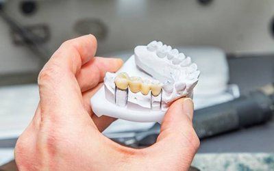 Model of dental crown supported fixed bridge