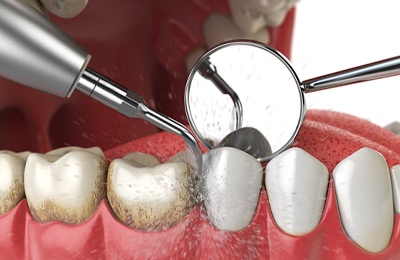 Scaling and root planing procedure to treat gum disease